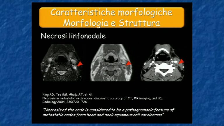 Diagnosi dei linfonodi maligni tramite ecografia: una guida completa