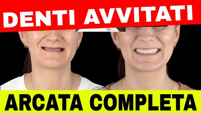 Come Ottenere un Sorriso Perfetto con l’Arcata Dentale Perfetta