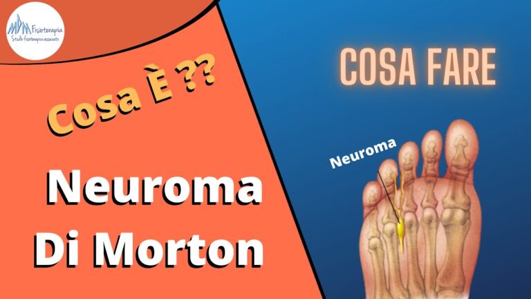 Neuroma di Morton: Comprendere il Tumore e le Sue Implicazioni