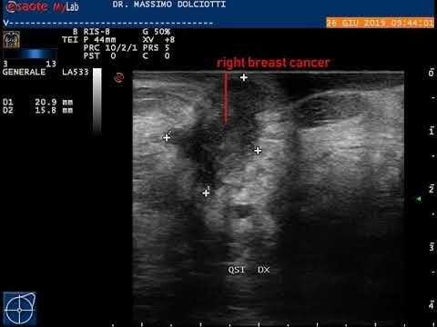 Carcinoma infiltrato: cause, sintomi e trattamenti
