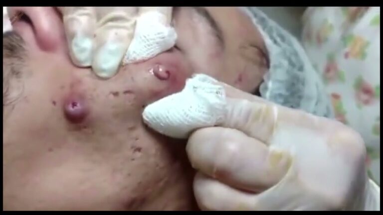 Come Eliminare i Brufoli Interni sulla Coscia