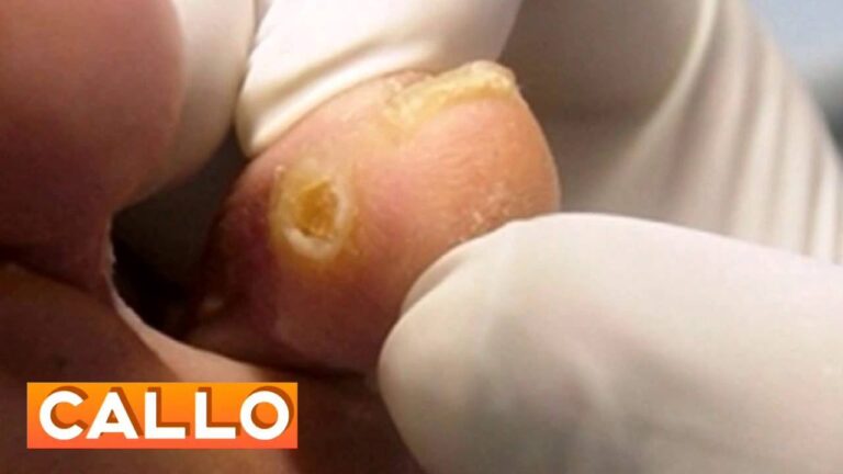 Guarire rapidamente dalla verruca con il trattamento del callo