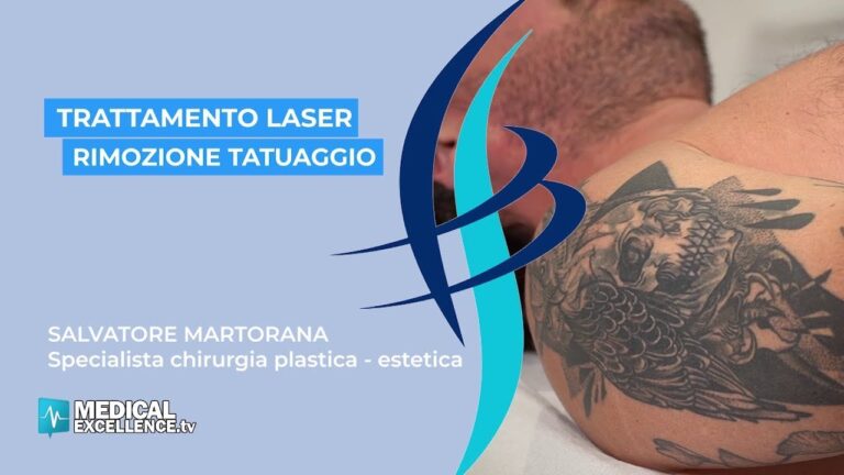 Rimozione dei Tatuaggi con Laser: Efficacia e Vantaggi