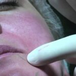 Ruolo dell’antitransglutaminasi IgA nella diagnosi della celiachia