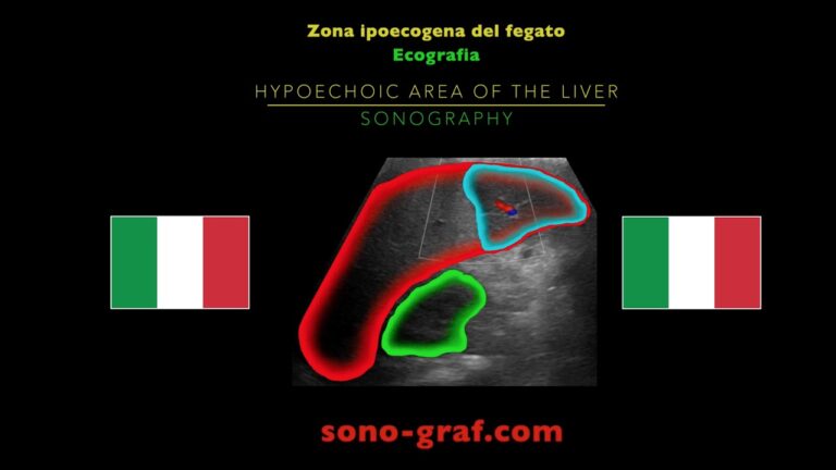 La Significato dell’Ipoecogena: Guida Completa