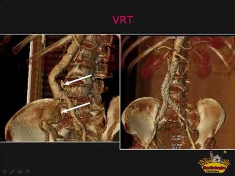 AngioTac Cerebrale: Guida Ottimizzata