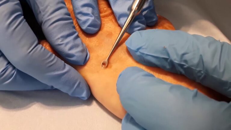 La Curettage in Dermatologia: Guida Completa