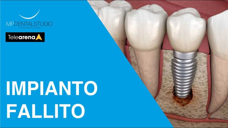 Sintomi di Rigetto nell’Innesto Osseo Dentale