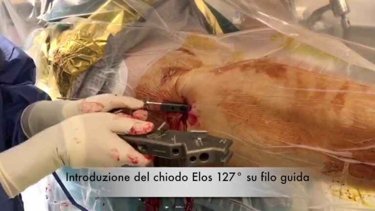 Chiodo nella Frattura del Femore: Guida Completa