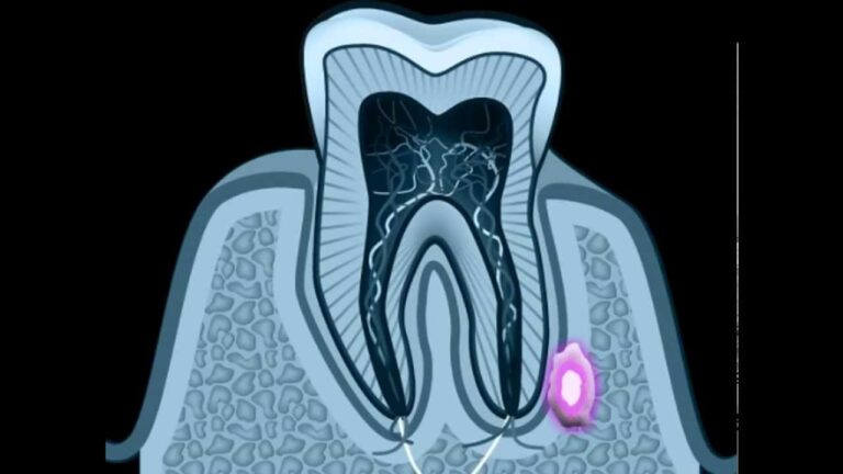 Cisti Sotto Dente: Cause, Sintomi e Trattamenti
