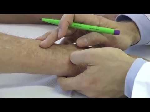 Sinovite della mano: sintomi, cause e trattamenti