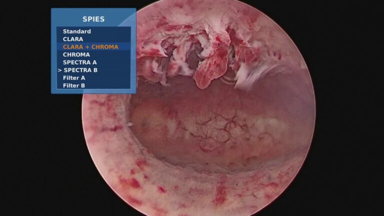 Endometrio ispessito durante la menopausa