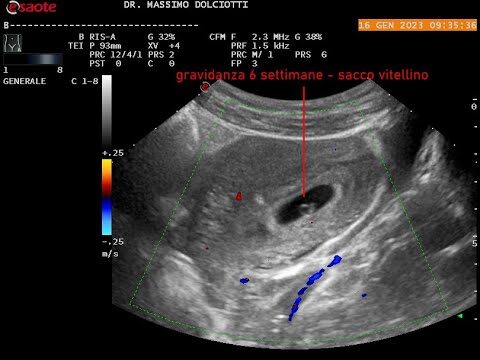 Dimensioni dell’embrione a 6 settimane: tutto ciò che devi sapere