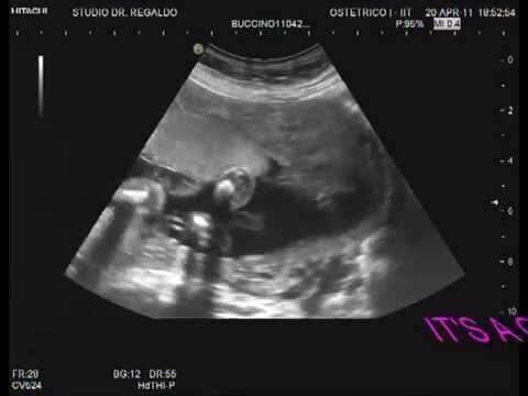 Test DNA fetale: rilevamento del genere del bambino tramite ecografia morfologica