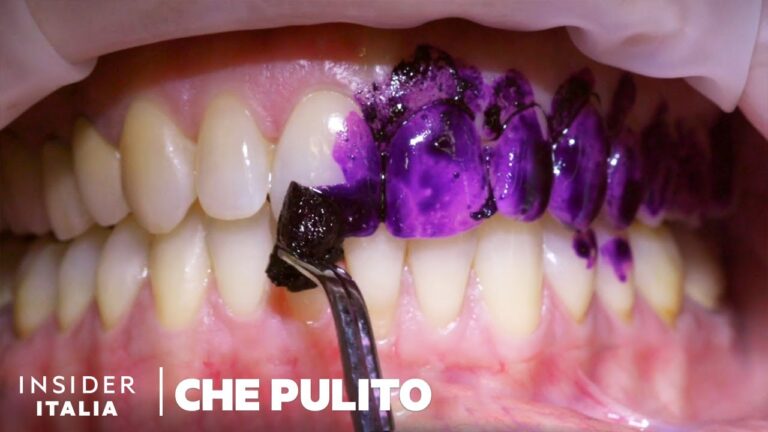 I Rischi della Pulizia Denti Troppo Aggressiva