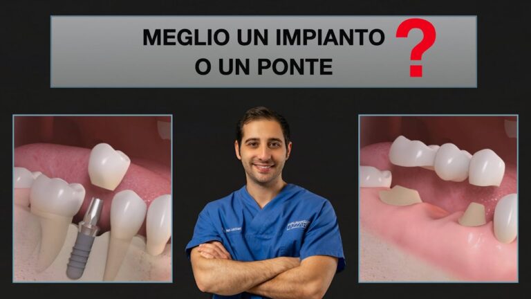 Costo di un Ponte Dentale: Guida Completa