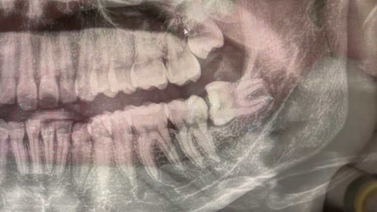 Guida al Dente del Giudizio Orizzontale