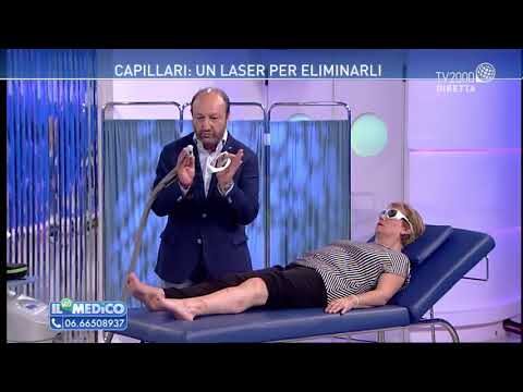 Prezzo Laser Capillari per Gambe: Efficacia e Convenienza