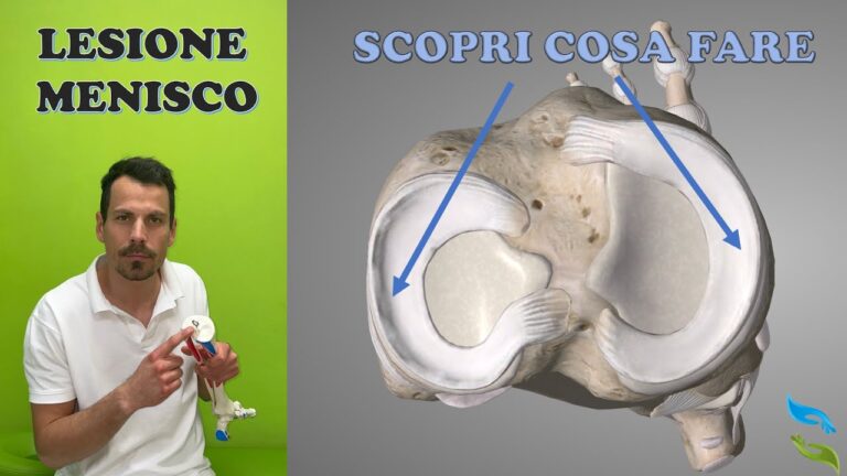 Menisco lesionato: Cosa Fare