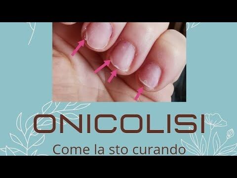 Trattamenti efficaci per l’onicolisi delle unghie delle mani