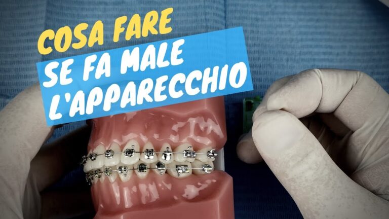 Rischi degli apparecchi ortodontici: cosa sapere