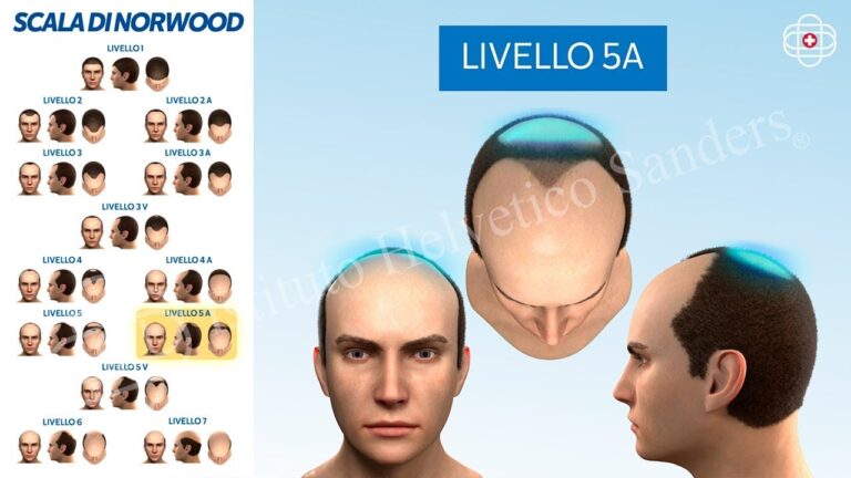Guida completa agli stadi dell’alopecia femminile