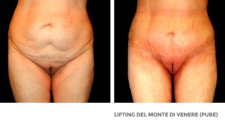 Monte di Venere Gonfio: Cause e Rimedi