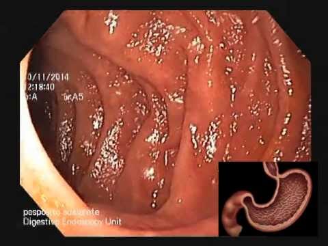 Costo della biopsia durante l’esofagogastroduodenoscopia
