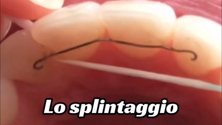 Costo del trattamento di splintaggio denti: tutto quello che devi sapere