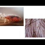Hyaluron Pen: i rischi nascosti di un trattamento cosmetico