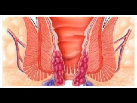 Comprendere e Trattare le Emorroidi a Grappolo