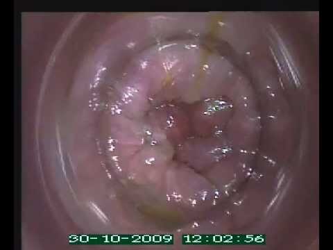 Trattamento del prolasso mucoso rettale