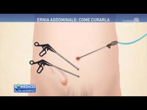 Ernia addominale: cure non invasive e alternative alla chirurgia