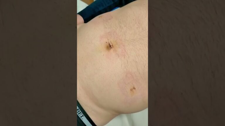 Laparoscopia per ernia inguinale: vantaggi e procedure