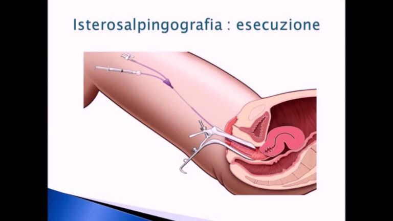Esame delle tube: la chiave per una gravidanza