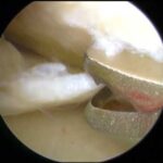 Ecografia Doppler delle Carotidi: Importanza e Applicazioni