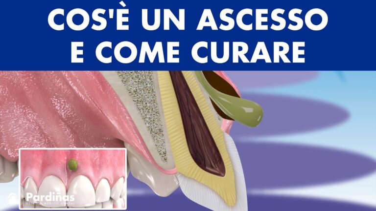 Devitalizzazione dentale per infezione: cosa sapere