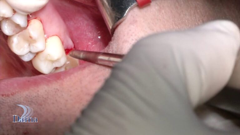 Costi delle Estrazioni Dentali: Guida Completa