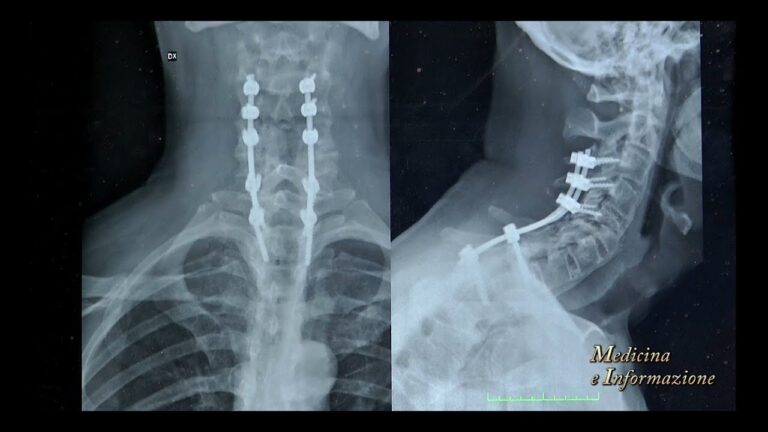 Comprendere l’Instabilità Cranio Cervicale: Cause e Soluzioni
