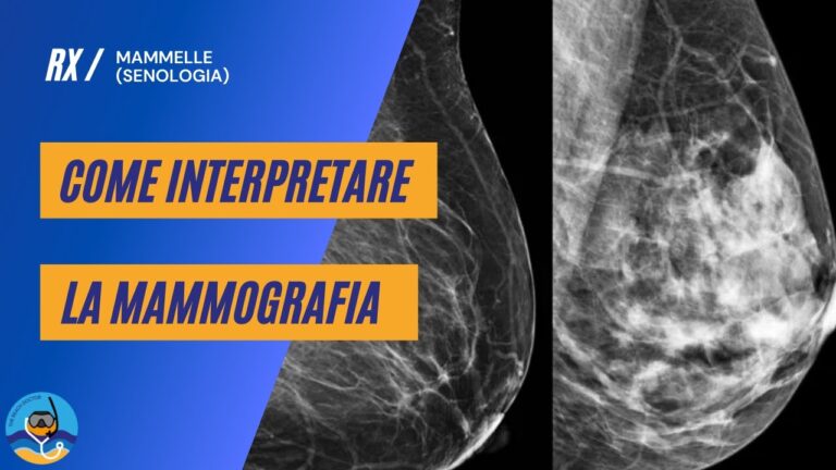 Seno Fibroghiandolare: Comprendere la Struttura e la Salute Mammaria