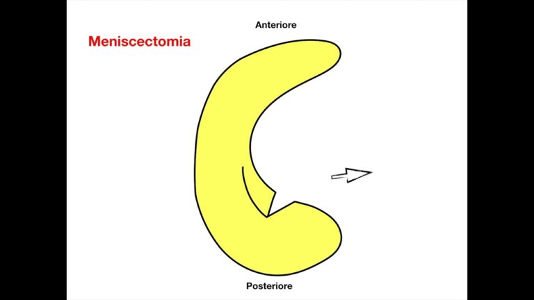 Fissurazione del Menisco Mediale: Focus sul Corno Posteriore