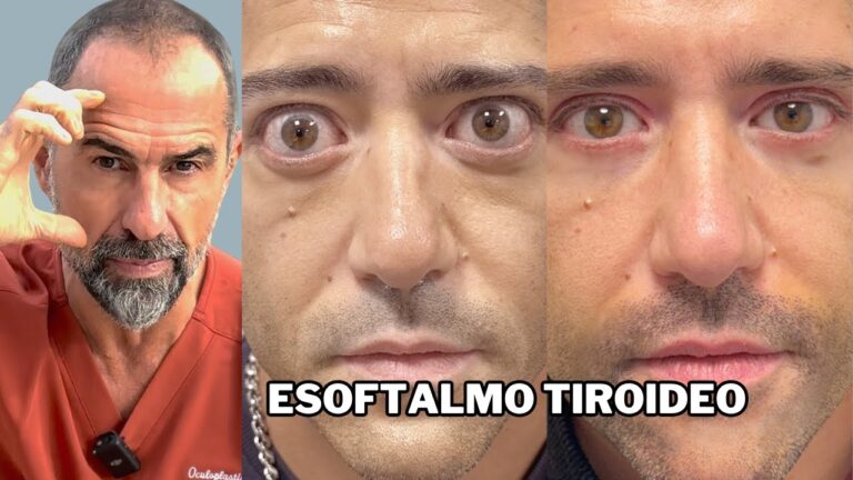 Esoftalmo Tiroideo: Cause, Sintomi e Trattamenti