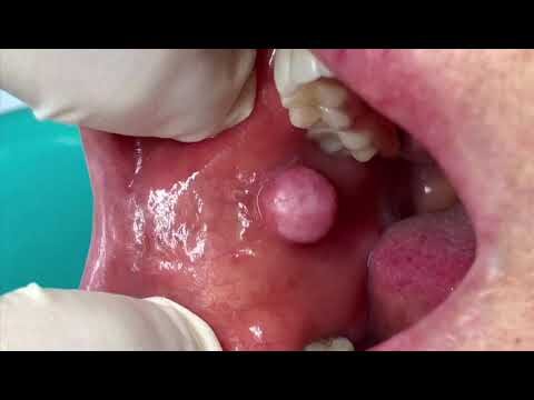 Mucosa Geniena: Funzioni e Importanza nella Salute Orale