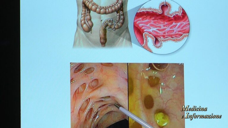 Uso dell’antibiotico per il trattamento dei diverticoli