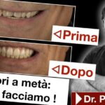 Costo dello sbiancamento dei denti