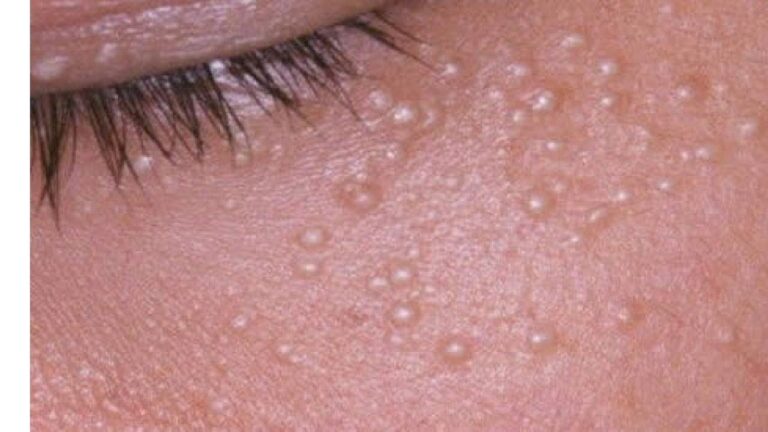 Bicarbonato: Soluzione Efficace per Eliminare le Palline di Grasso