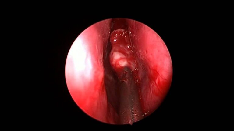 Sintomi della Sinusite Mascellare Odontogena