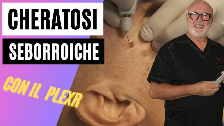 Trattamento Efficace per Cheratosi Seborroica: Pomate Consigliate
