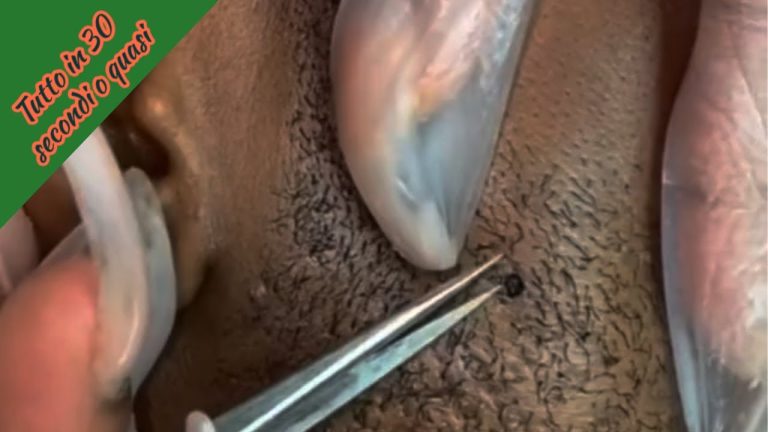 Peli Incarniti: Cause e Rimedi per la Pube