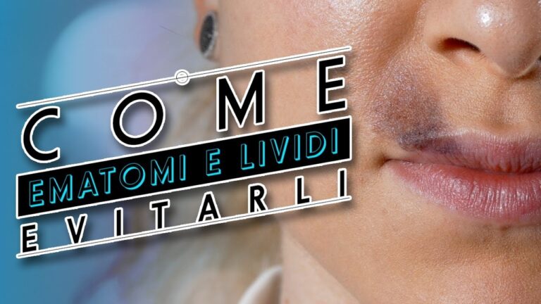 Pomata Efficace per Ematomi da Filler